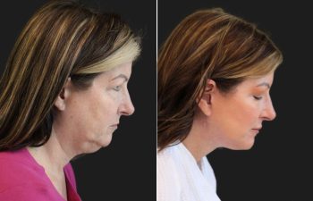 Side-by-side profile photos of a woman before and after cosmetic surgery, showing a more defined jawline and smoother neck in the after image. "MAIA" logo appears in the bottom right corner.