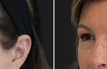 Side-by-side comparison of a woman's face before and after a cosmetic procedure, showing visible improvements in skin texture and brow area.