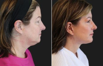 Side-by-side profile photos of a woman before and after a cosmetic procedure, showing noticeable reduction in chin and neck fullness.