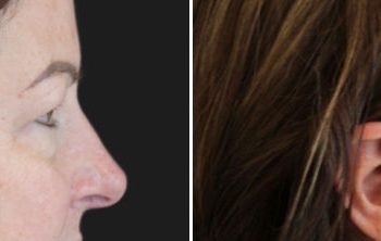 Side-by-side profile photos of a woman before and after a cosmetic procedure, showing changes in her skin texture and facial contours.
