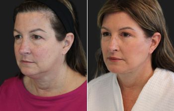 Side-by-side comparison of a woman before and after a cosmetic procedure, showing smoother skin and enhanced facial contours in the after image.