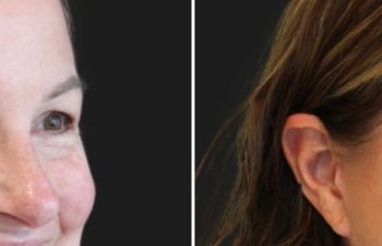 Side-by-side comparison showing a woman's face before and after a cosmetic procedure, highlighting smoother skin and reduced wrinkles around the eyes.