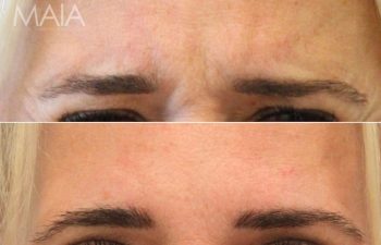 60-year-old patient before and 7 weeks after Botox to the forehead and glabella (11 lines), showing smoother, more relaxed appearance.