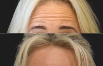 60-year-old patient before and 7 weeks after Botox to the forehead and glabella (11 lines), showing smoother, more relaxed appearance.