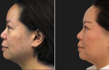 45-year-old patient before and after 3 sessions of Morpheus8 with Exosomes and Clear+Brilliant, performed by Nurse Erin.