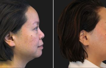 45-year-old patient before and after 3 sessions of Morpheus8 with Exosomes and Clear+Brilliant, performed by Nurse Erin.