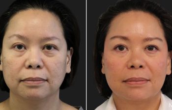 45-year-old patient before and after 3 sessions of Morpheus8 with Exosomes and Clear+Brilliant, performed by Nurse Erin.