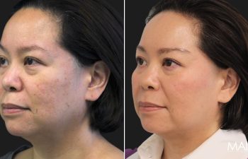 45-year-old patient before and after 3 sessions of Morpheus8 with Exosomes and Clear+Brilliant, performed by Nurse Erin.