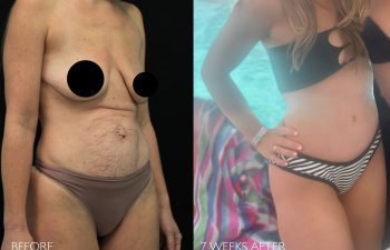 35 year old before and 7 weeks after mommy makeover (extended tummy tuck, hernia repair, and breast lift)