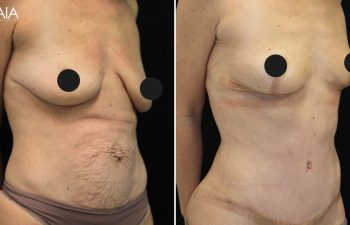 35 year old before and 7 weeks after mommy makeover (extended tummy tuck, hernia repair, and breast lift)