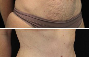 35 year old before and 7 weeks after mommy makeover (extended tummy tuck, hernia repair, and breast lift)
