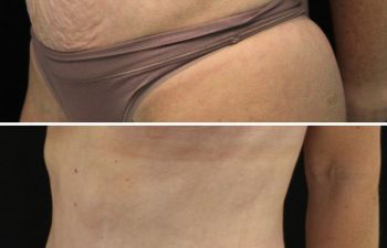 35 year old before and 7 weeks after mommy makeover (extended tummy tuck, hernia repair, and breast lift)