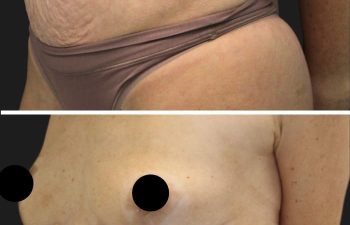 35 year old before and 7 weeks after mommy makeover (extended tummy tuck, hernia repair, and breast lift)