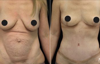 35 year old before and 7 weeks after mommy makeover (extended tummy tuck, hernia repair, and breast lift)
