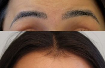 25-year-old woman before and 2 weeks after Xeomin injections in forehead, glabella, and crow’s feet, showing smoother skin and natural-looking results without heaviness or frozen expression.