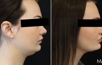 26-year-old patient before and 3 months after awake neck liposuction: subtle contour improvement with minimal downtime and no general anesthesia.
