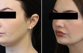 26-year-old patient before and 3 months after awake neck liposuction: subtle contour improvement with minimal downtime and no general anesthesia.