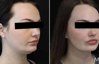 26-year-old patient before and 3 months after awake neck liposuction: subtle contour improvement with minimal downtime and no general anesthesia.