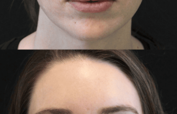 35-year-old woman before and 2 days after 1 CoolPeel treatment by Nurse Erin Ochs, showing improved pigmentation and skin tone with minimal downtime before her wedding.