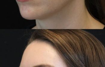 35-year-old woman before and 2 days after 1 CoolPeel treatment by Nurse Erin Ochs, showing improved pigmentation and skin tone with minimal downtime before her wedding.