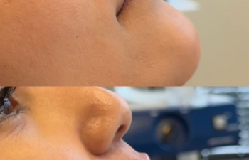 Side-by-side before and after images of a person’s lower face showing lip enhancement; the bottom image displays fuller, glossier lips.