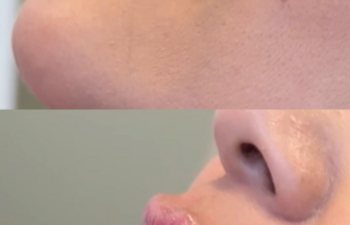 Side-by-side close-up of a person's lower face before and after a cosmetic lip enhancement, showing fuller lips in the after image.