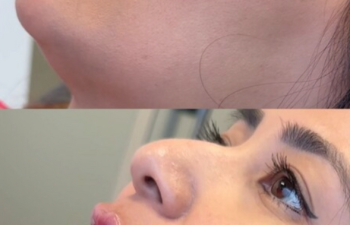 Side-by-side comparison of a woman's face before (top) and after (bottom) a cosmetic procedure, showing fuller lips and enhanced facial contours.