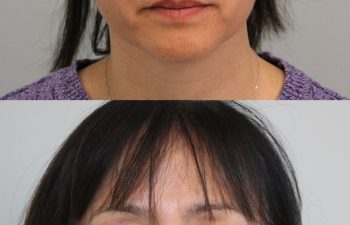 55-year-old female before and 2 weeks after one CoolPeel session – improved skin texture, reduced pigmentation, smoother and firmer under-eye area.