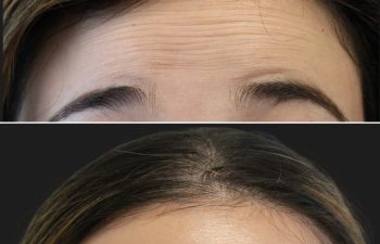 Close-up of a person's forehead before and after treatment, showing reduction of horizontal wrinkles and smoother skin in the after image.
