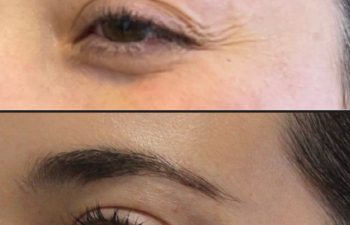 Close-up of the same person's eye area shown in two images: the top image shows wrinkles, while the bottom image shows smoother skin with fewer visible lines.