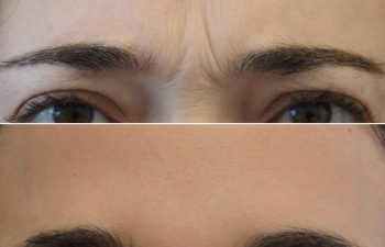 Close-up of a person’s forehead and eyes, showing deep frown lines in the top image and a smoother forehead without lines in the bottom image.