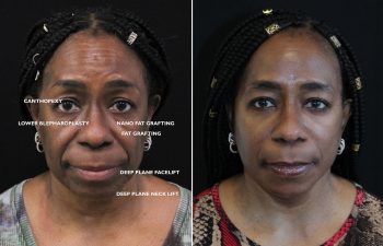 Side-by-side photos of a woman before and 11 weeks after facial cosmetic procedures, showing visible changes in her facial appearance.