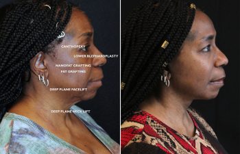 Side-by-side profile photos of a woman before and 11 weeks after facial cosmetic procedures, including facelift, neck lift, blepharoplasty, and fat grafting.