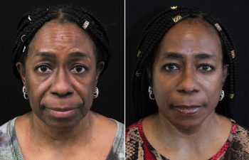 Side-by-side portraits of a woman before and after a cosmetic procedure, showing changes in facial appearance. "MAIA" logo is visible in the bottom right corner.