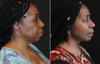 Side-by-side profile photos of a woman before and after a cosmetic procedure, showing smoother skin and a more defined jawline in the after image.