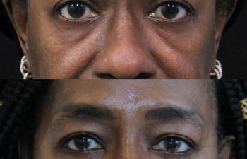 Close-up comparison of a woman’s face before (top) and after (bottom) a cosmetic procedure, showing reduced under-eye bags and smoother skin in the after image.