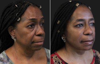 Side-by-side comparison of a woman before and after a cosmetic facial procedure, showing smoother skin and reduced under-eye lines in the after image.