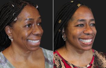Side-by-side comparison of a woman before and after a cosmetic procedure, both images show her smiling against a plain dark background. "MAIA" logo is visible in the bottom right corner.