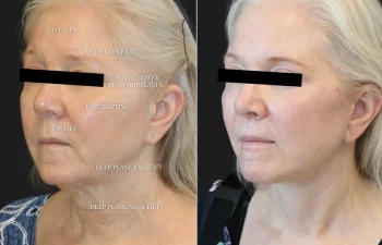 Side-by-side photos of a woman before and five months after multiple facial procedures, showing visible changes in skin texture and facial contours. Labels indicate procedures in the "before" image.