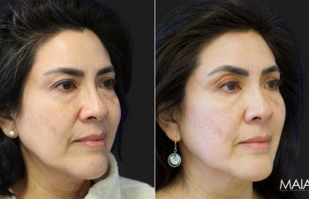 Side-by-side comparison of a woman's face before and after a cosmetic procedure, showing smoother skin and improved complexion on the right.