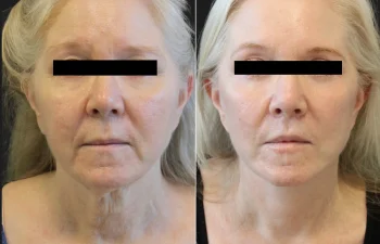 Side-by-side photos of an older woman before and 5 months after a cosmetic procedure, showing smoother skin and a more defined jawline in the after image.