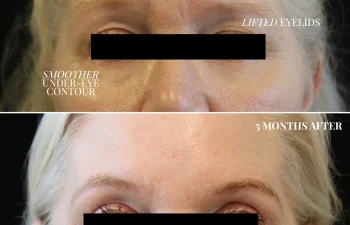 Before and after photos of a woman's face showing changes in brow position, eyelid lift, under-eye contour, and skin texture 5 months after a cosmetic procedure. Eyes are blacked out.