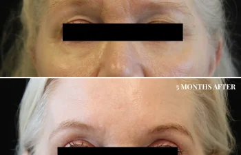 Close-up of a woman's eye area before and five months after a cosmetic procedure, showing reduced eyelid drooping and smoother skin in the after image. Eyes are censored for privacy.