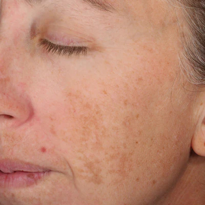 Woman’s face after treatment with A-LUMINATE Brightening Serum – reduced dark spots and more even, brighter skin tone.