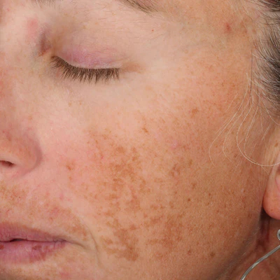 Woman’s face before treatment with A-LUMINATE Brightening Serum – visible dark spots and uneven skin tone.