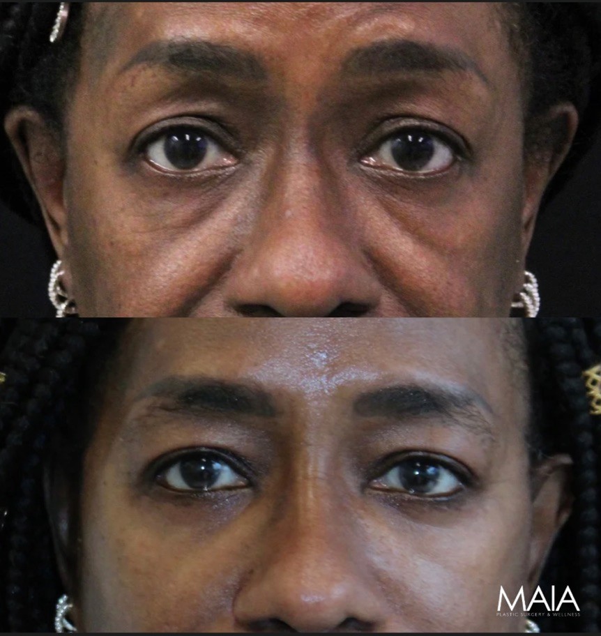 Close-up of a woman's face in two images: the top shows under-eye bags and wrinkles, while the bottom shows smoother skin with reduced under-eye bags. A 'MAIA' logo appears in the lower right corner.
