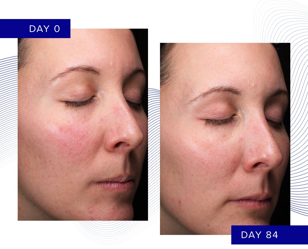 Side-by-side images showing facial skin before (Day 0) and after 84 days of treatment with RETINOL + EMULSION 0.3. Right image shows reduced fine lines and improved skin clarity.