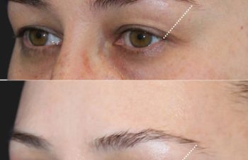 Close-up, side-by-side view of the same person’s right eye before (top) and 5 weeks after (bottom) upper eyelid lift and mini brow lift—showing a rejuvenated eye area with lifted brow and smoother upper eyelids.