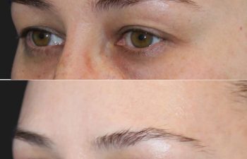 Close-up, side-by-side comparison of a person's right eye and eyebrow area before (top) and 5 weeks after (bottom) upper eyelid lift and mini brow lift, showing a rejuvenated look with lifted brow and smoother upper lids.