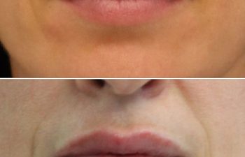 Close-up images of the lips of a 44-year-old before and after lip filler treatment by Nurse Practitioner Kristina using 0.35 ml of Versa Lips, showing increased lip volume and glossiness in the after image.
